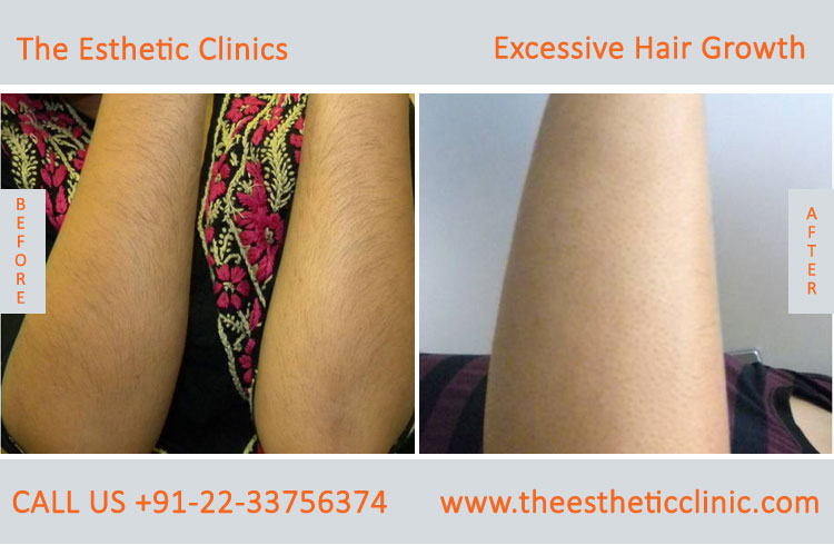 Excessive Hair Growth Removal Treatment before after photos in mumbai india (9)